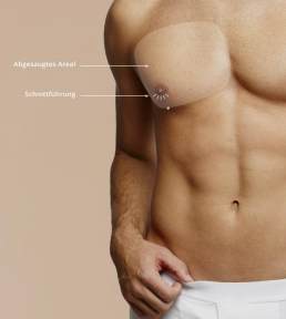 Subkutane Mastektomie Liposuktion