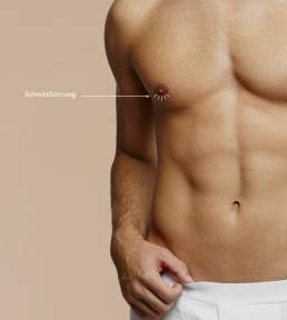 Subkutane Mastektomie